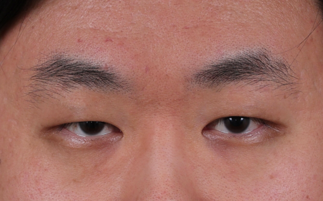 Blepharoplasty Before & After Gallery - Patient 402892 - Image 1