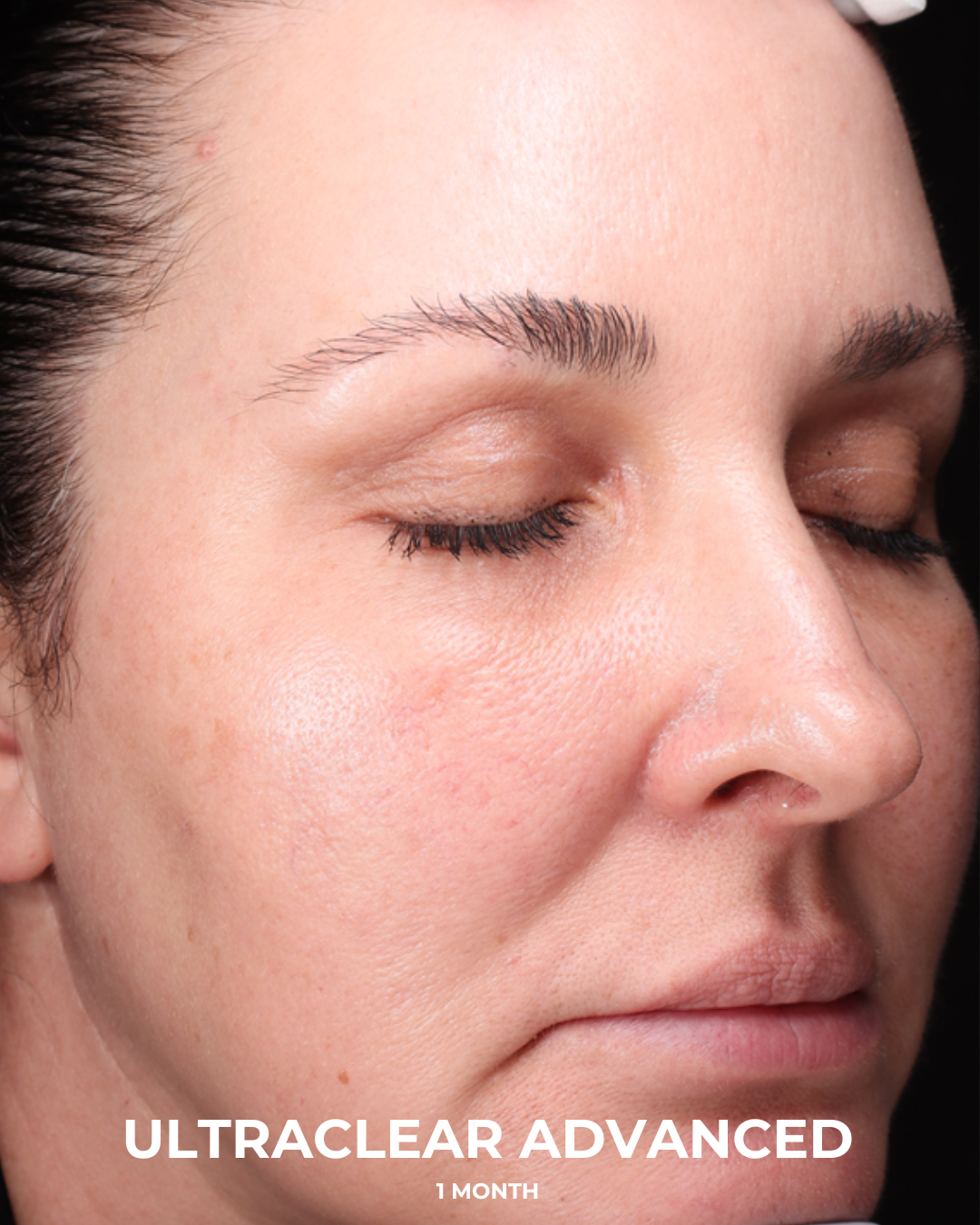 UltraClear Before & After Gallery - Patient 223793 - Image 4