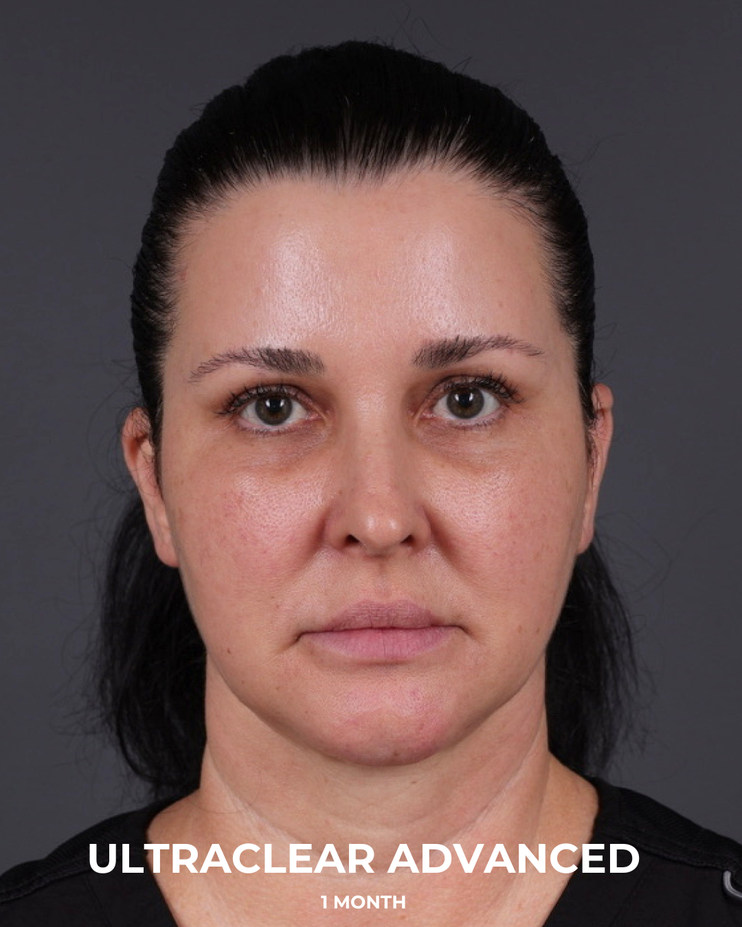 UltraClear Before & After Gallery - Patient 223793 - Image 8