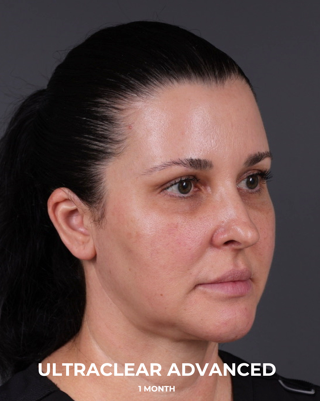 UltraClear Before & After Gallery - Patient 223793 - Image 10