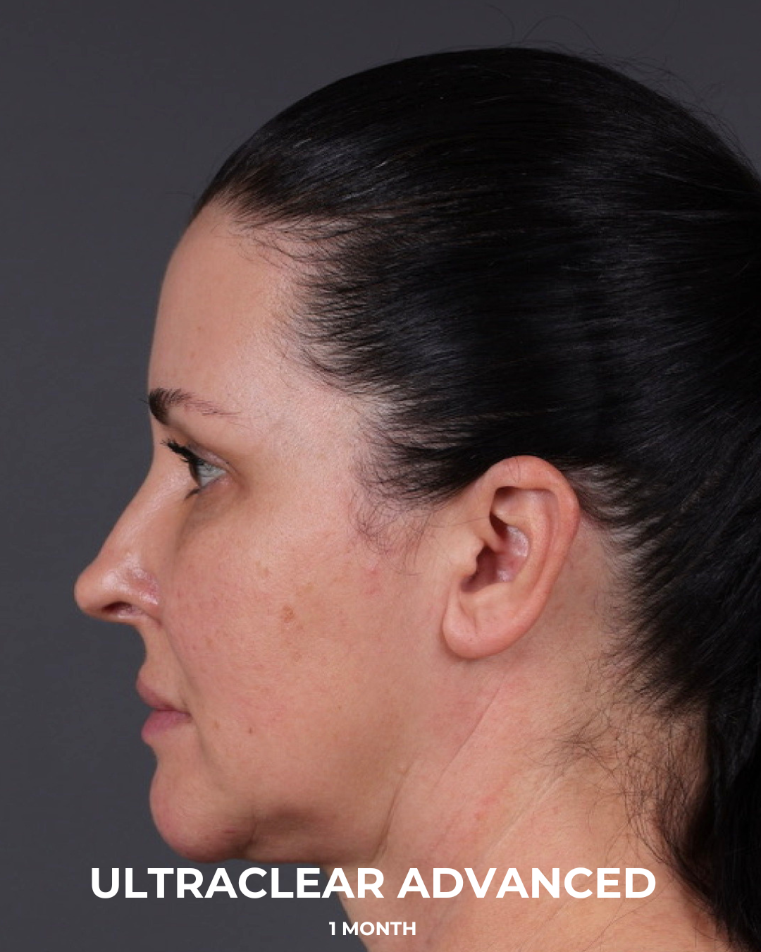 UltraClear Before & After Gallery - Patient 223793 - Image 14