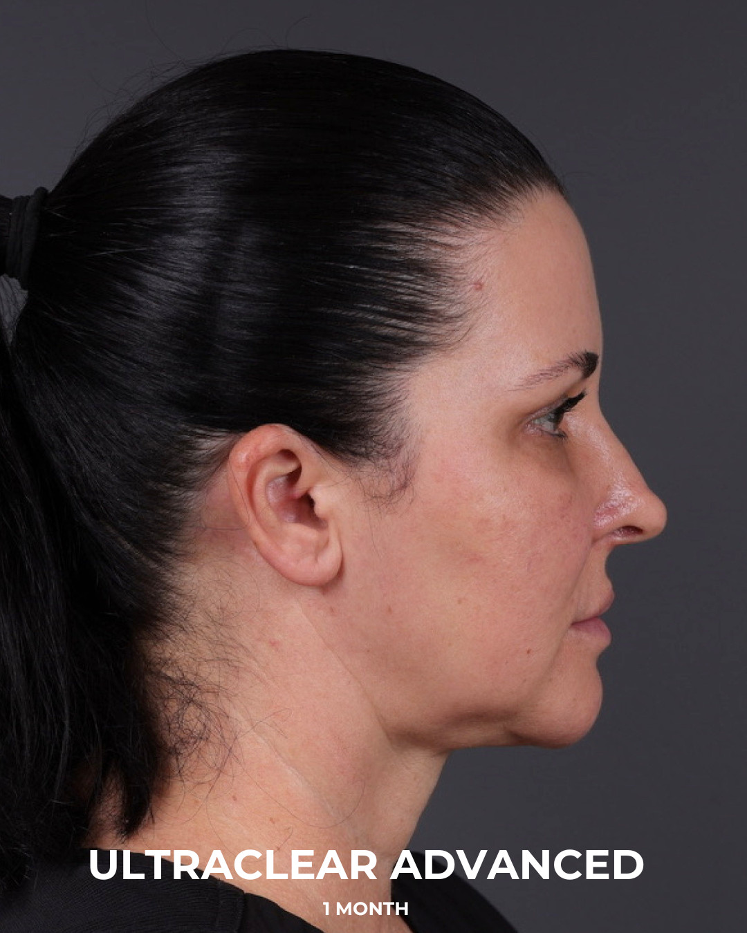 UltraClear Before & After Gallery - Patient 223793 - Image 12