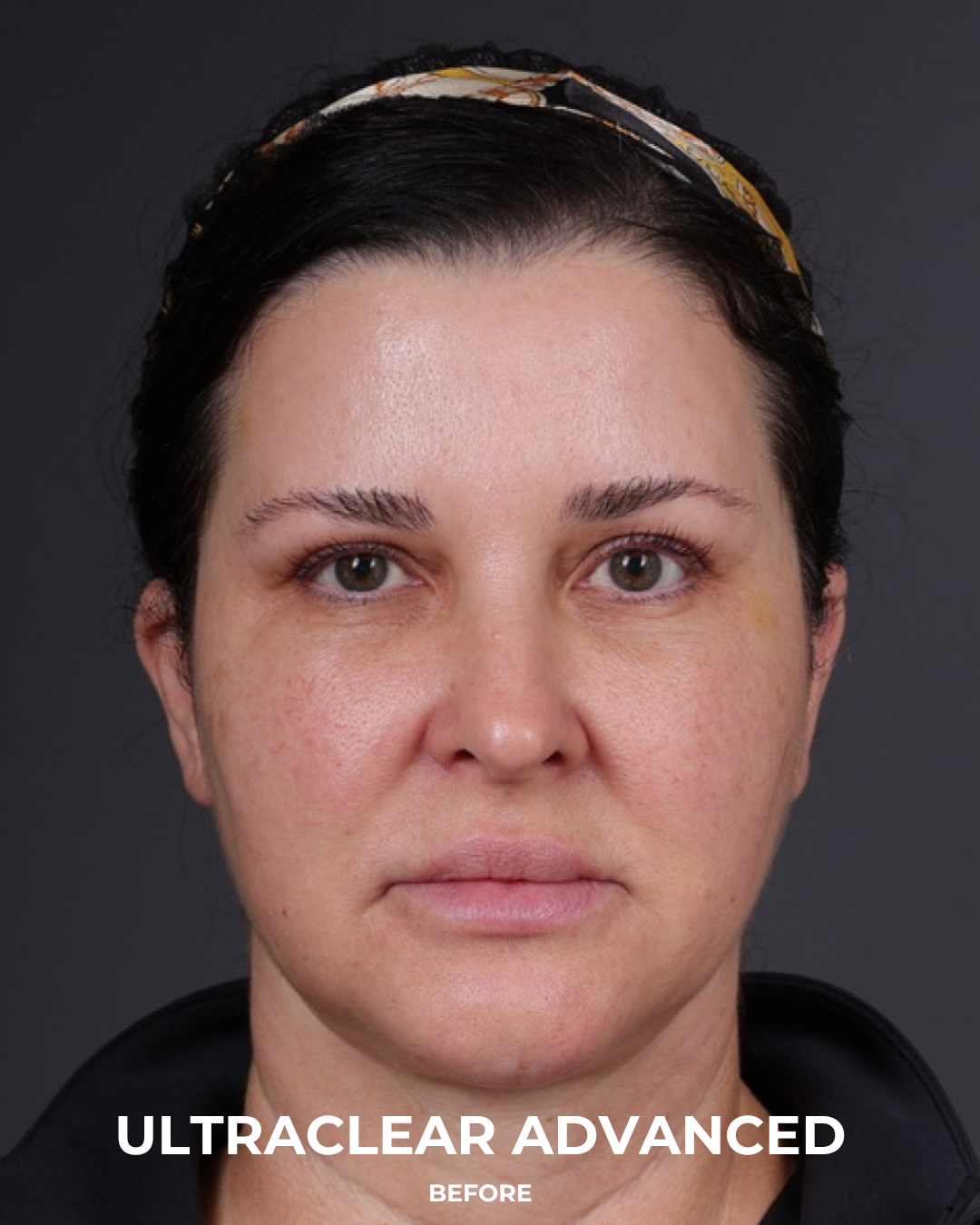 UltraClear Before & After Gallery - Patient 223793 - Image 7