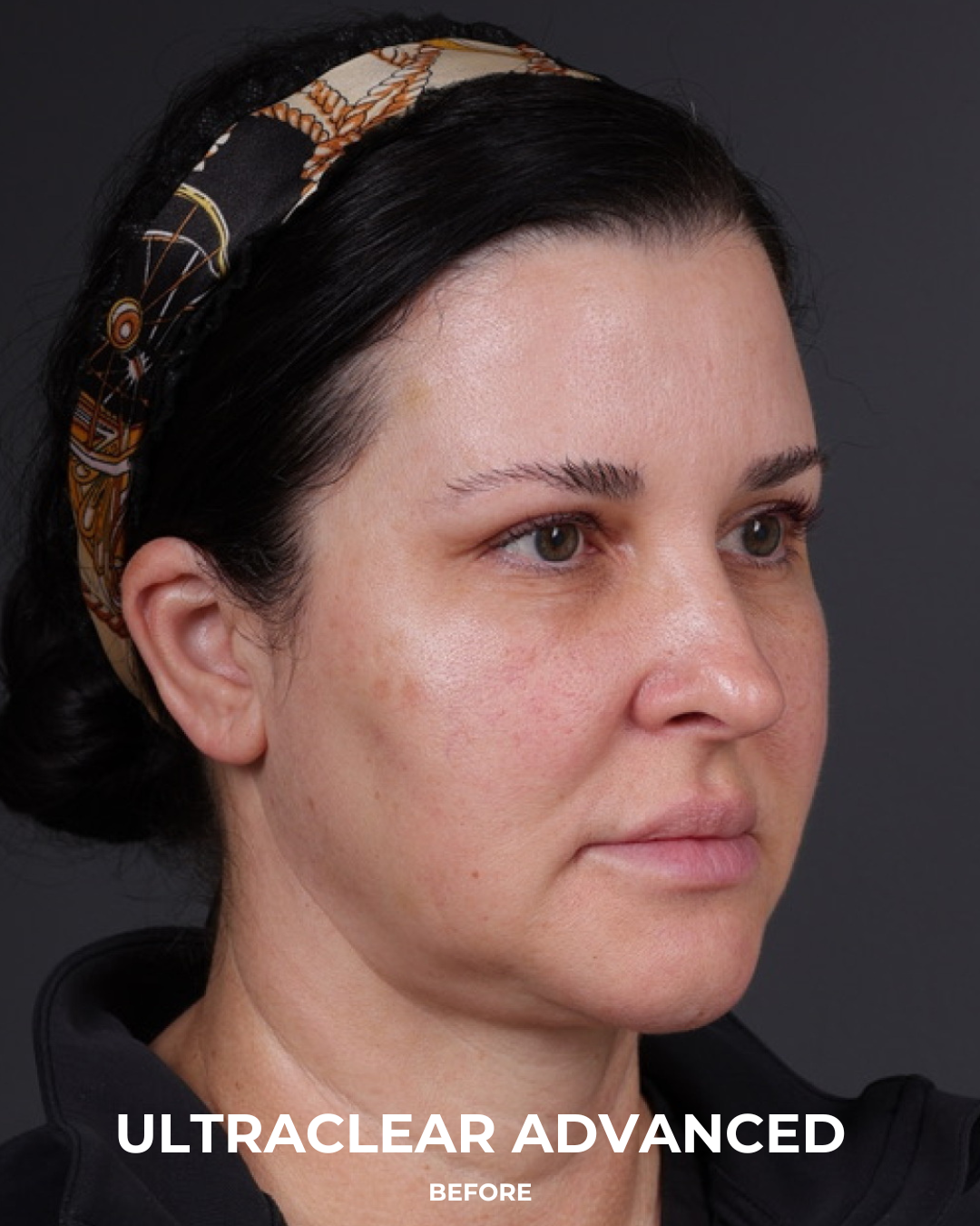 UltraClear Before & After Gallery - Patient 223793 - Image 9