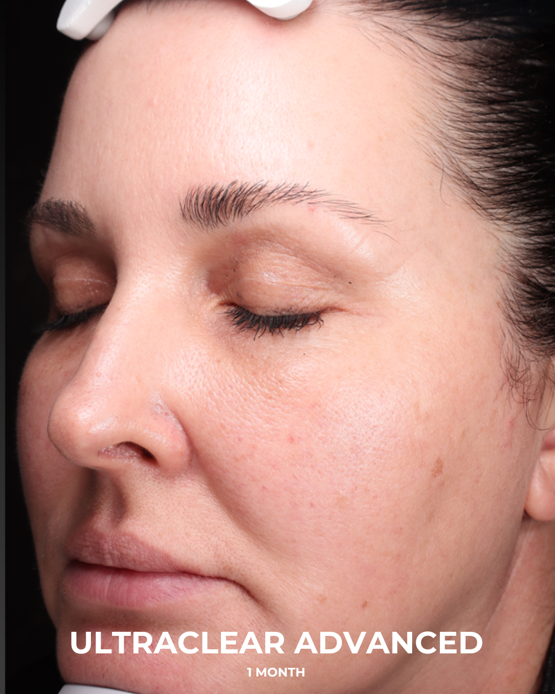 UltraClear Before & After Gallery - Patient 223793 - Image 6