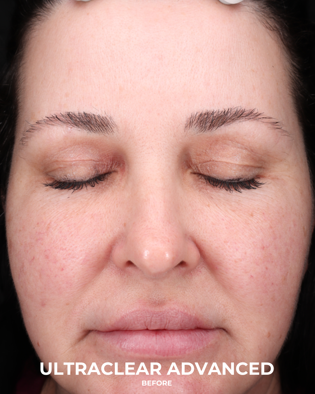 UltraClear Before & After Gallery - Patient 223793 - Image 1