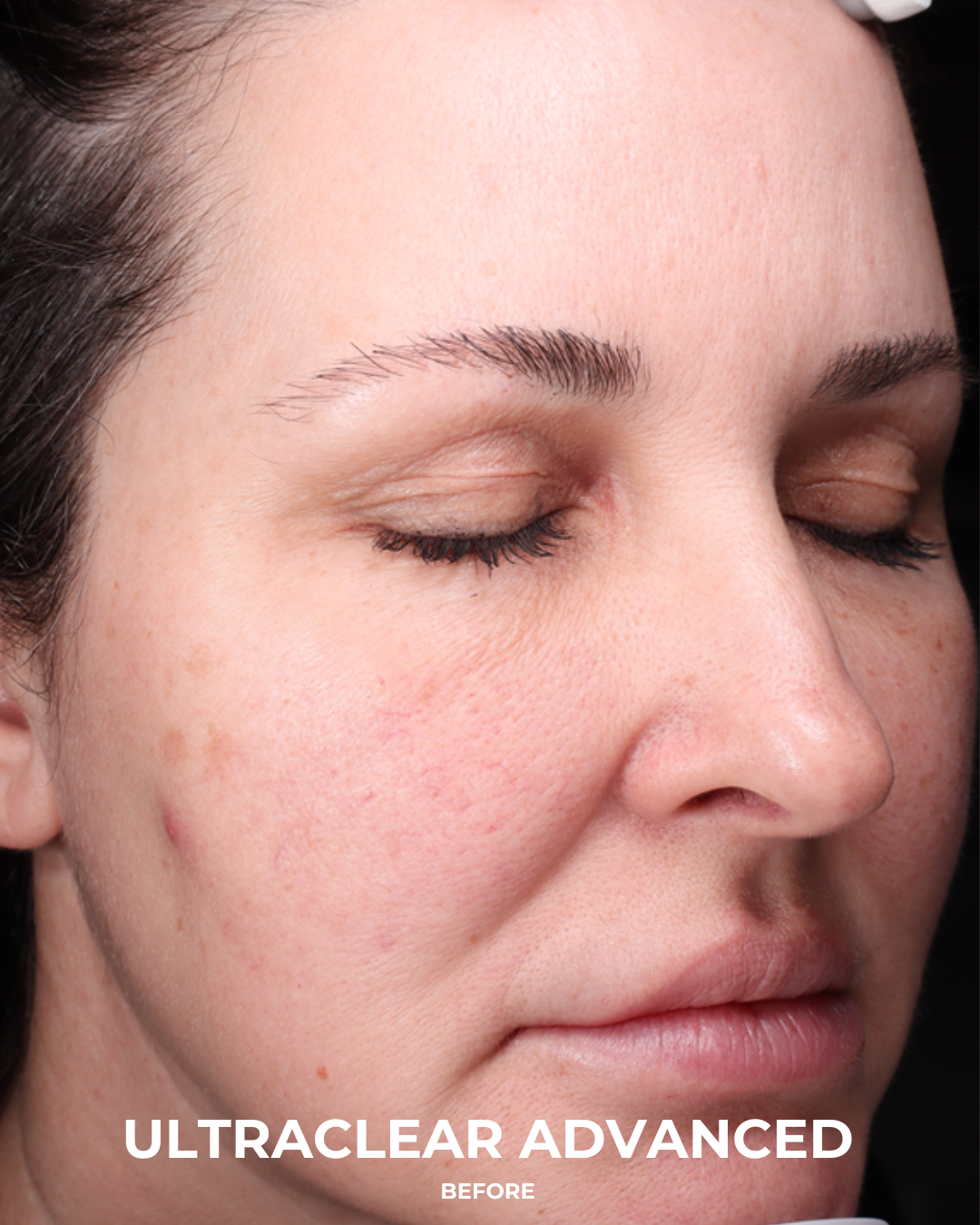 UltraClear Before & After Gallery - Patient 223793 - Image 3