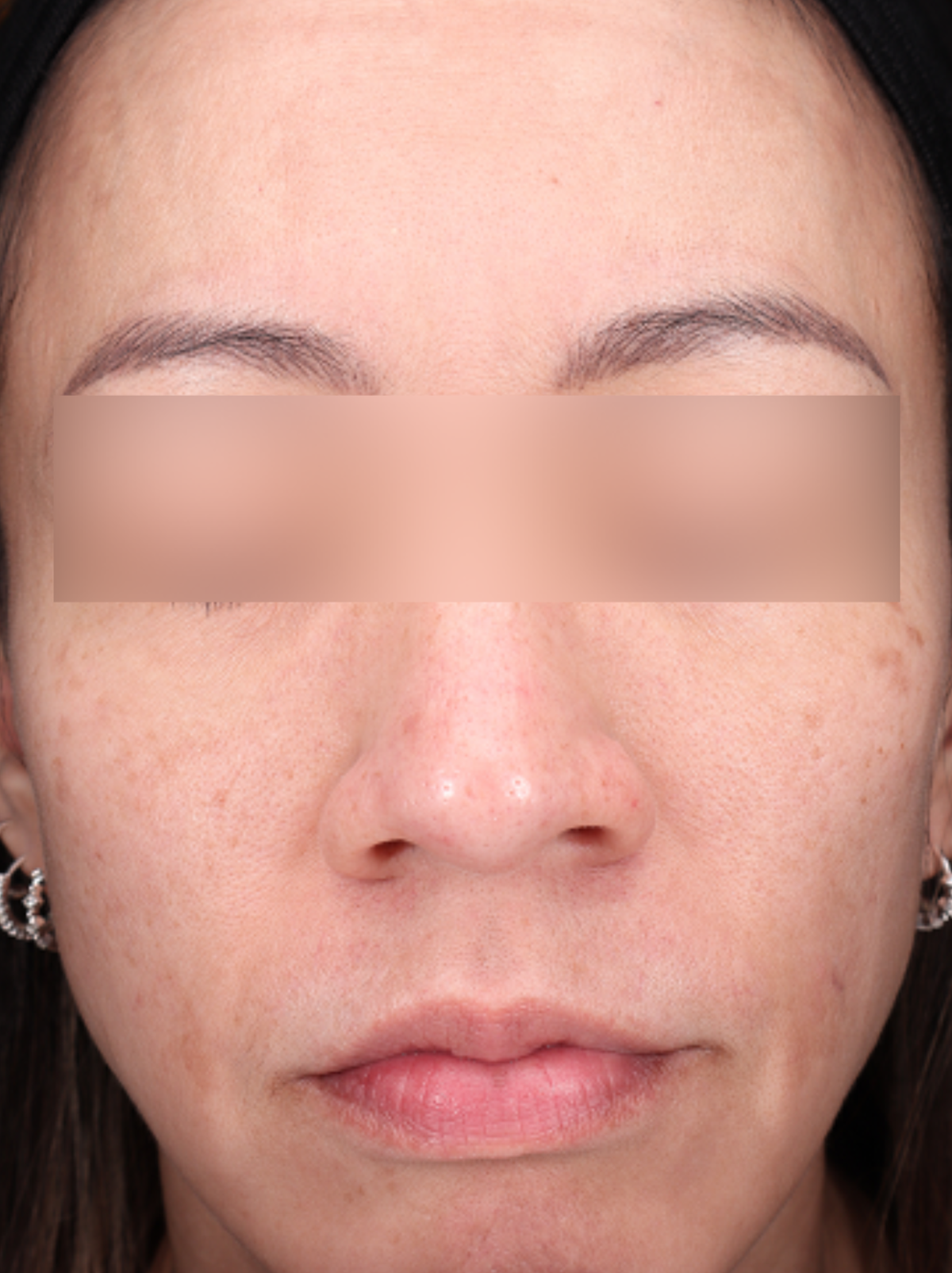 VI Peel Before & After Gallery - Patient 228367 - Image 2