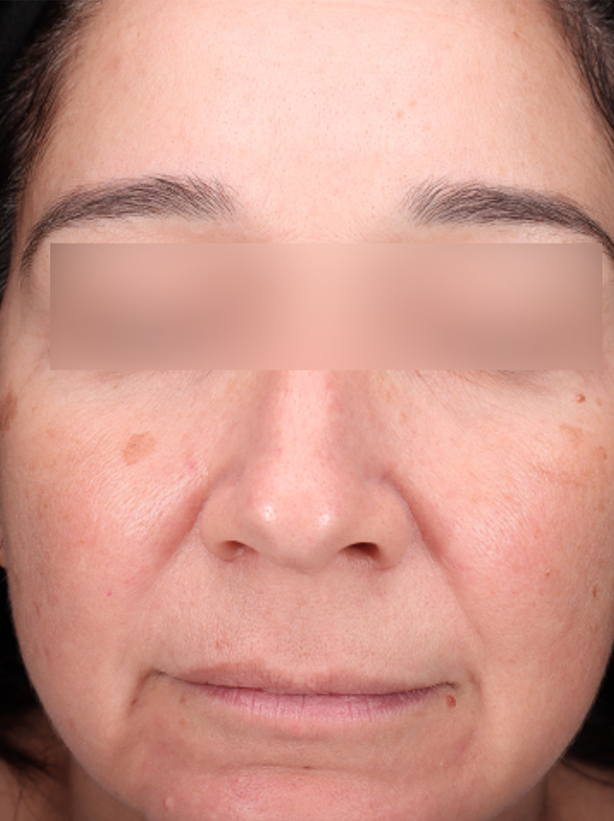 Pigment Laser Before & After Gallery - Patient 372700 - Image 1
