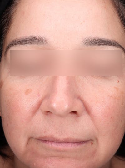 Pigment Laser Before & After Gallery - Patient 372700 - Image 1