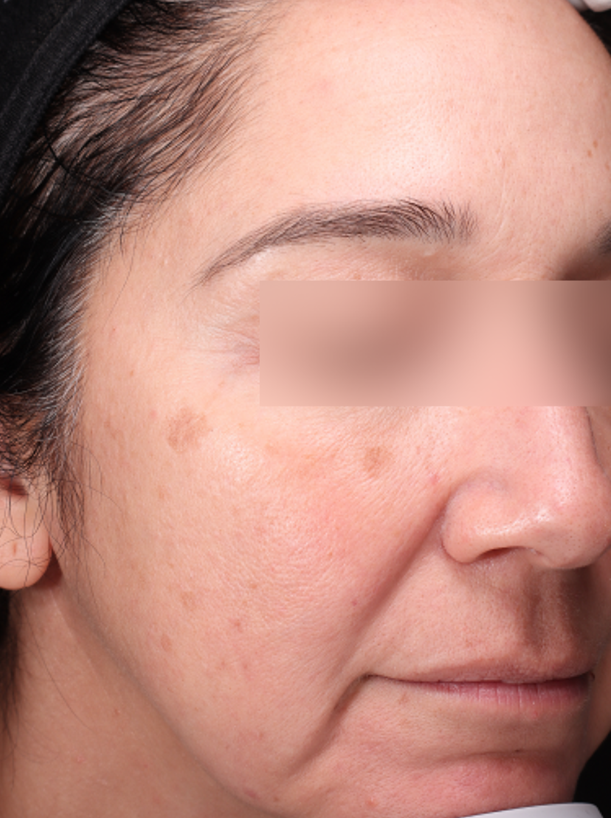 Pigment Laser Before & After Gallery - Patient 372700 - Image 3