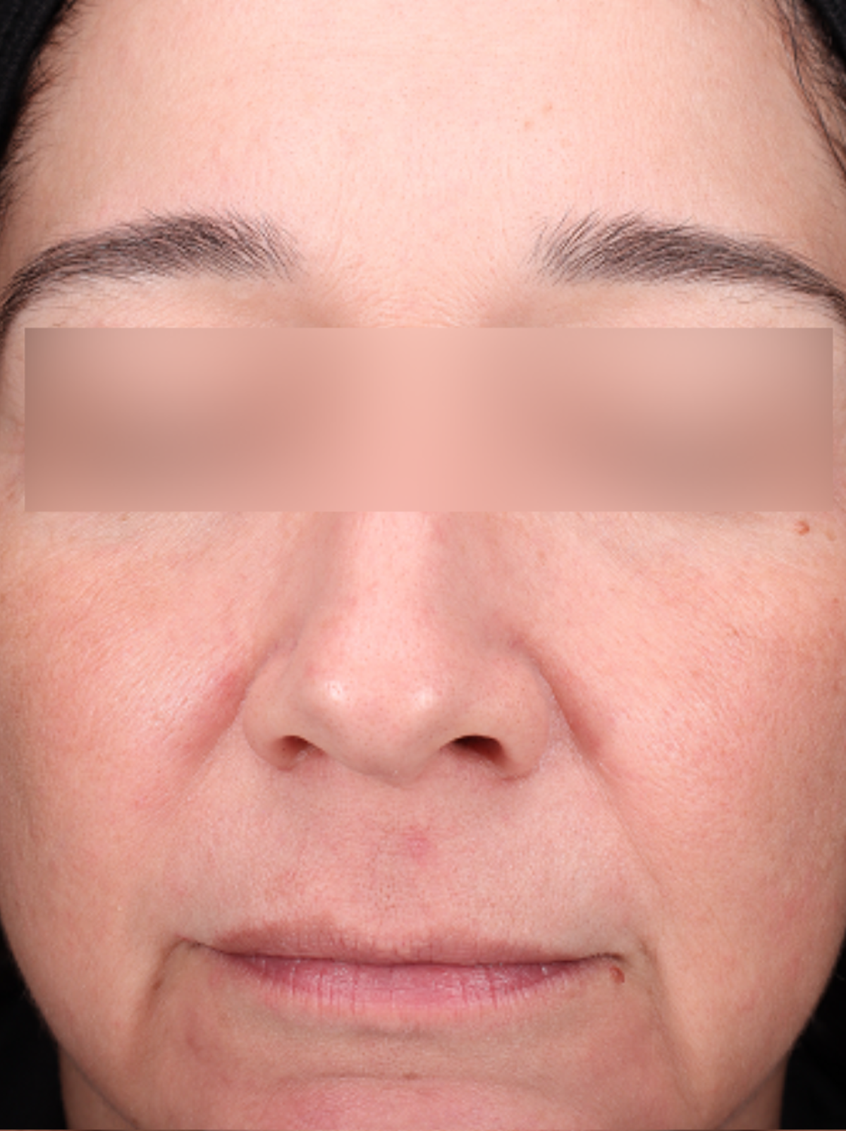 Pigment Laser Before & After Gallery - Patient 372700 - Image 2