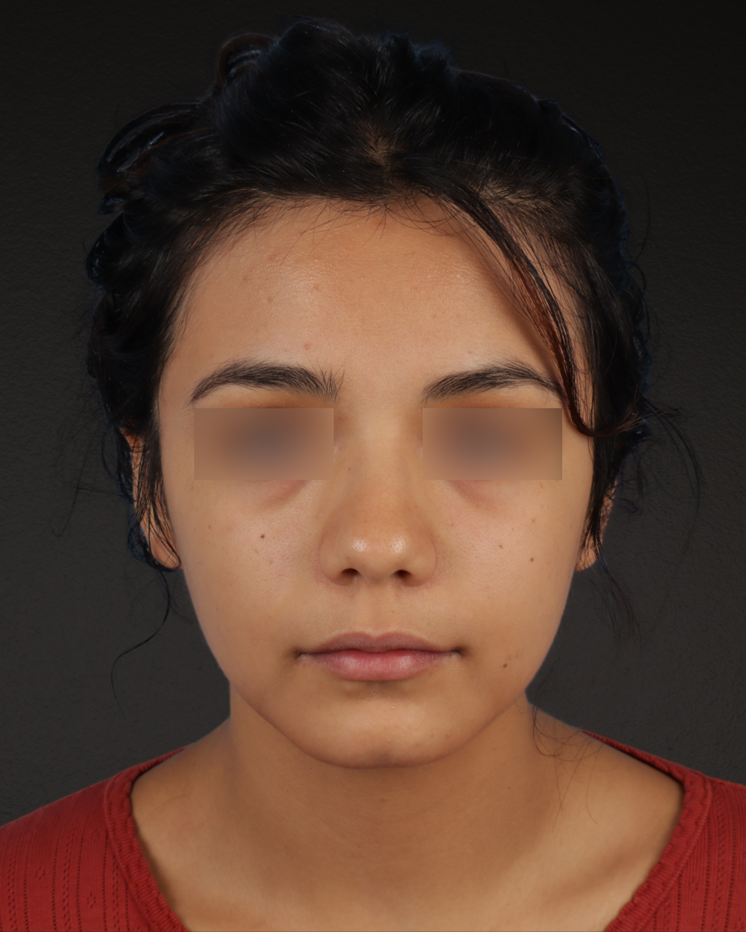 Rhinoplasty Before & After Gallery - Patient 342648 - Image 5
