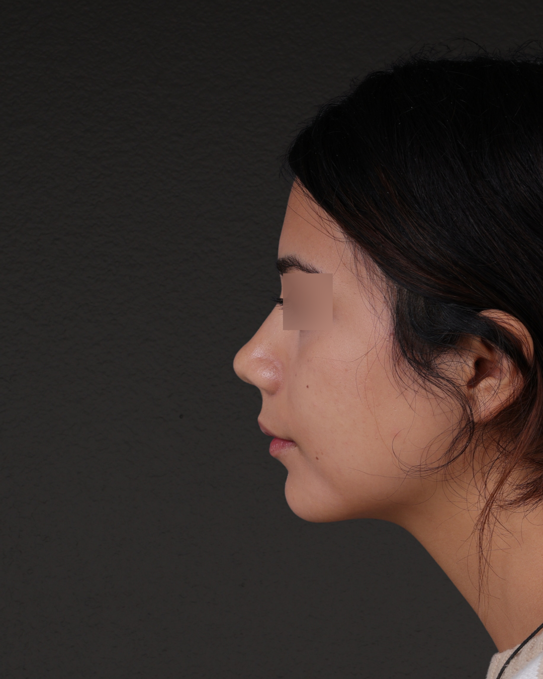 Rhinoplasty Before & After Gallery - Patient 342648 - Image 4