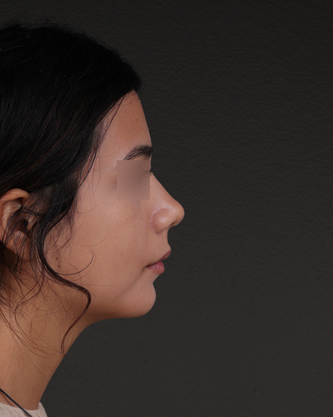 Rhinoplasty Before & After Gallery - Patient 342648 - Image 2