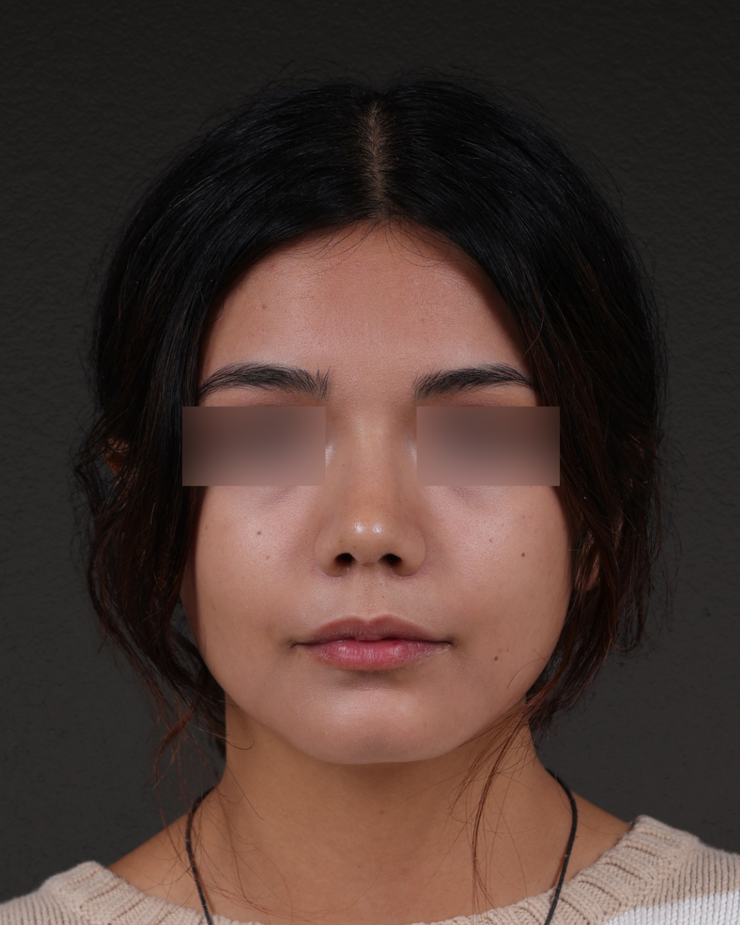 Rhinoplasty Before & After Gallery - Patient 342648 - Image 6