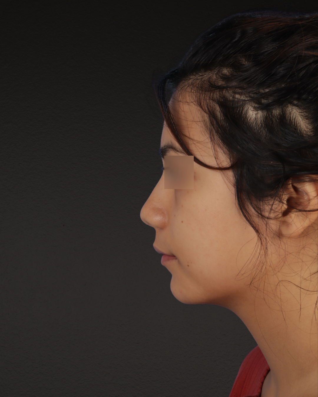 Rhinoplasty Before & After Gallery - Patient 342648 - Image 3