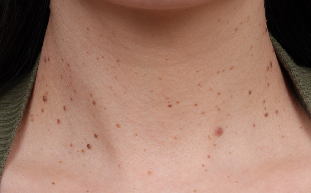 BBL Laser Before & After Gallery - Patient 949626 - Image 1