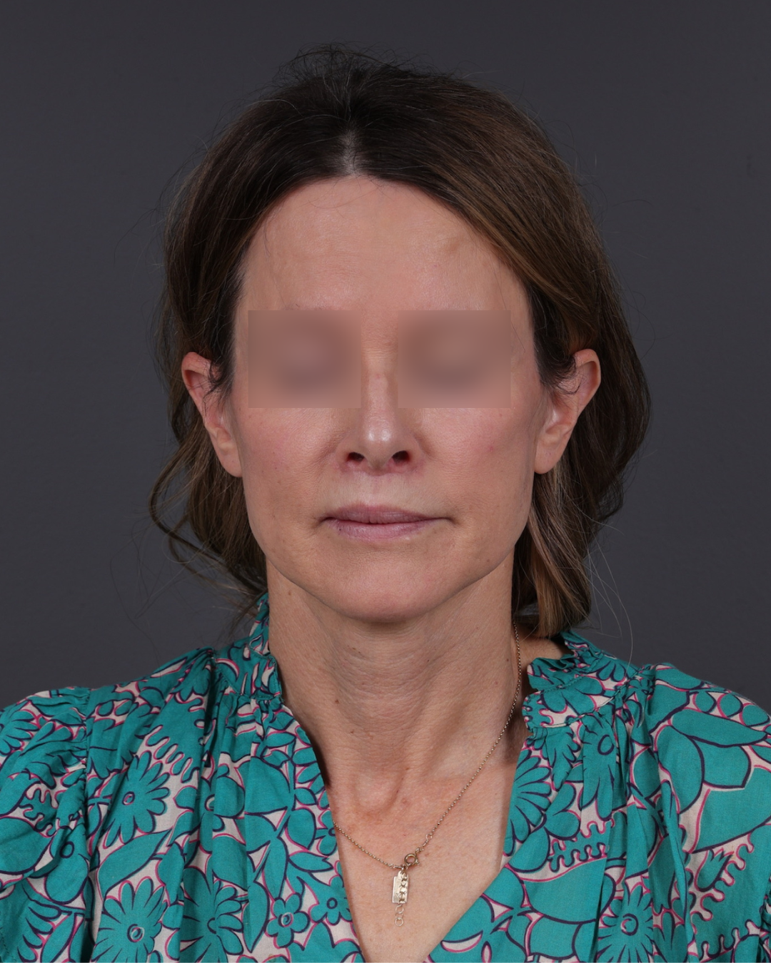 Facelift Before & After Gallery - Patient 263076 - Image 2