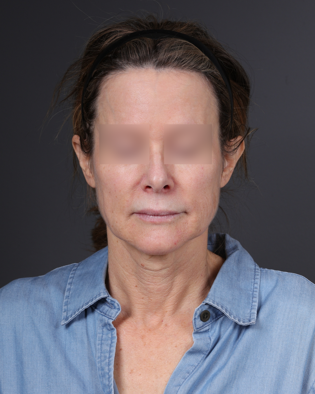 Facelift Before & After Gallery - Patient 263076 - Image 1