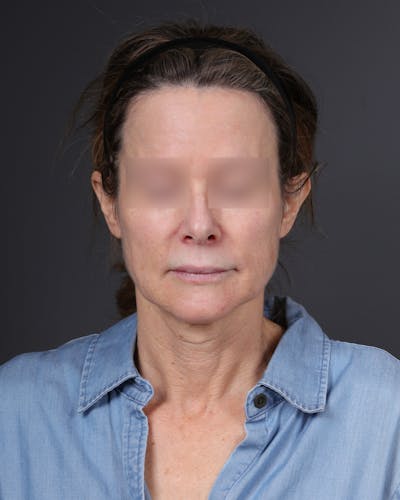 Facelift Before & After Gallery - Patient 263076 - Image 1