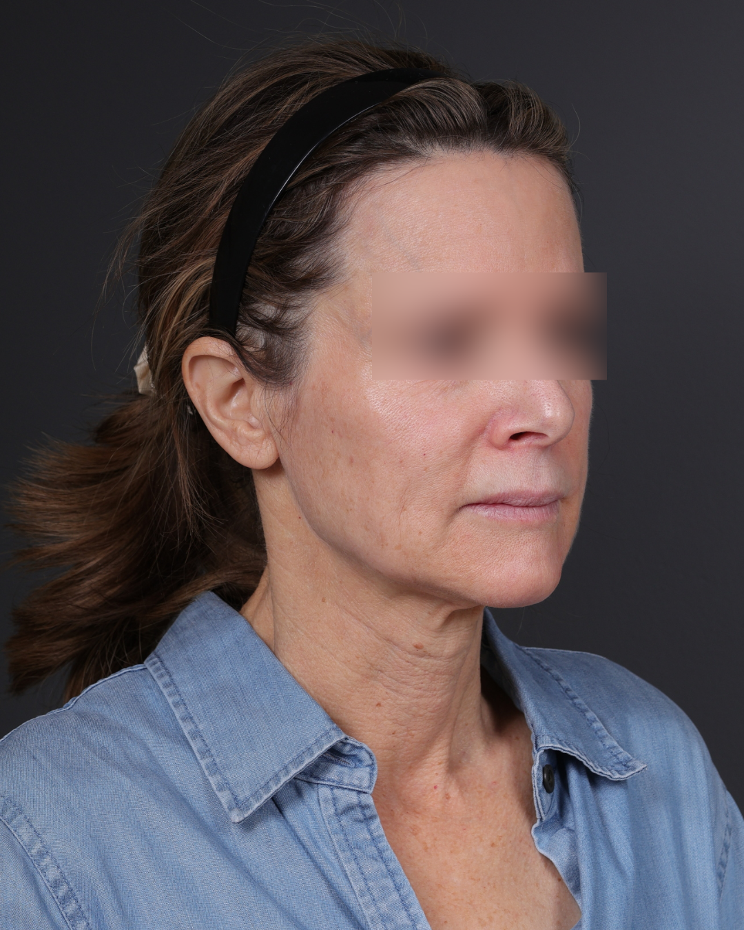 Facelift Before & After Gallery - Patient 263076 - Image 3