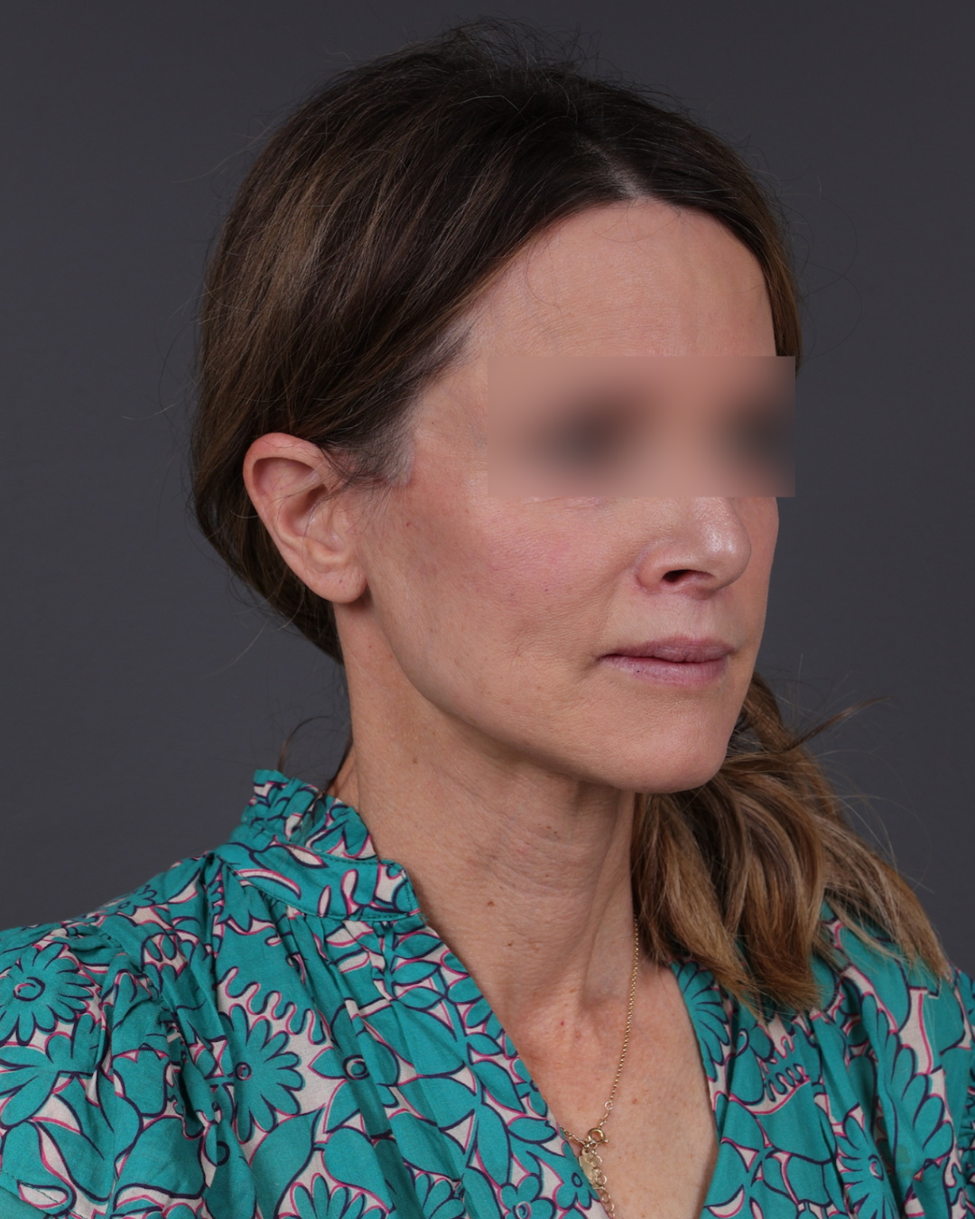 Facelift Before & After Gallery - Patient 263076 - Image 4
