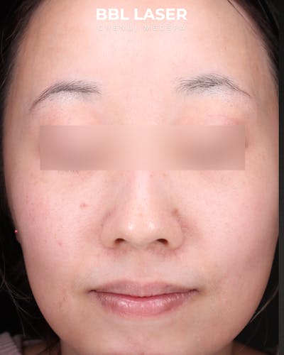 BBL Laser Before & After Gallery - Patient 157854 - Image 1