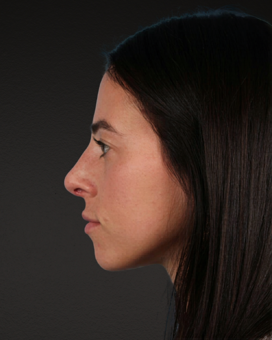 Rhinoplasty Before & After Gallery - Patient 172099 - Image 4