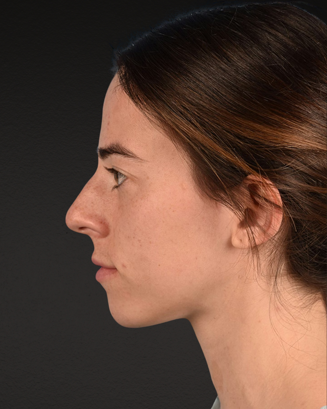Rhinoplasty Before & After Gallery - Patient 172099 - Image 3