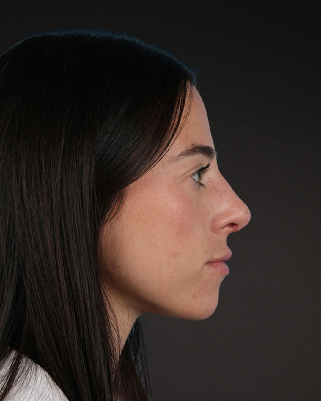 Rhinoplasty Before & After Gallery - Patient 172099 - Image 2