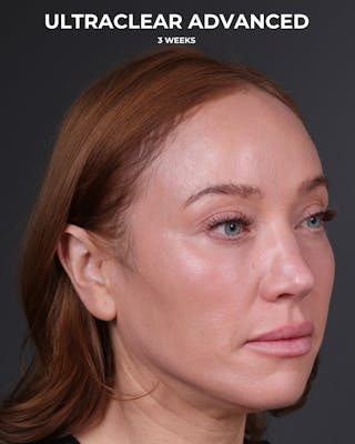 UltraClear Before & After Gallery - Patient 225417 - Image 4