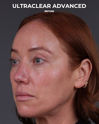 UltraClear Before & After Gallery - Patient 225417 - Image 5