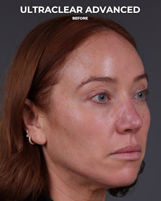 UltraClear Before & After Gallery - Patient 225417 - Image 3