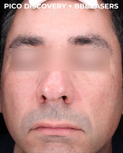 Pigment Laser Before & After Gallery - Patient 304692 - Image 2