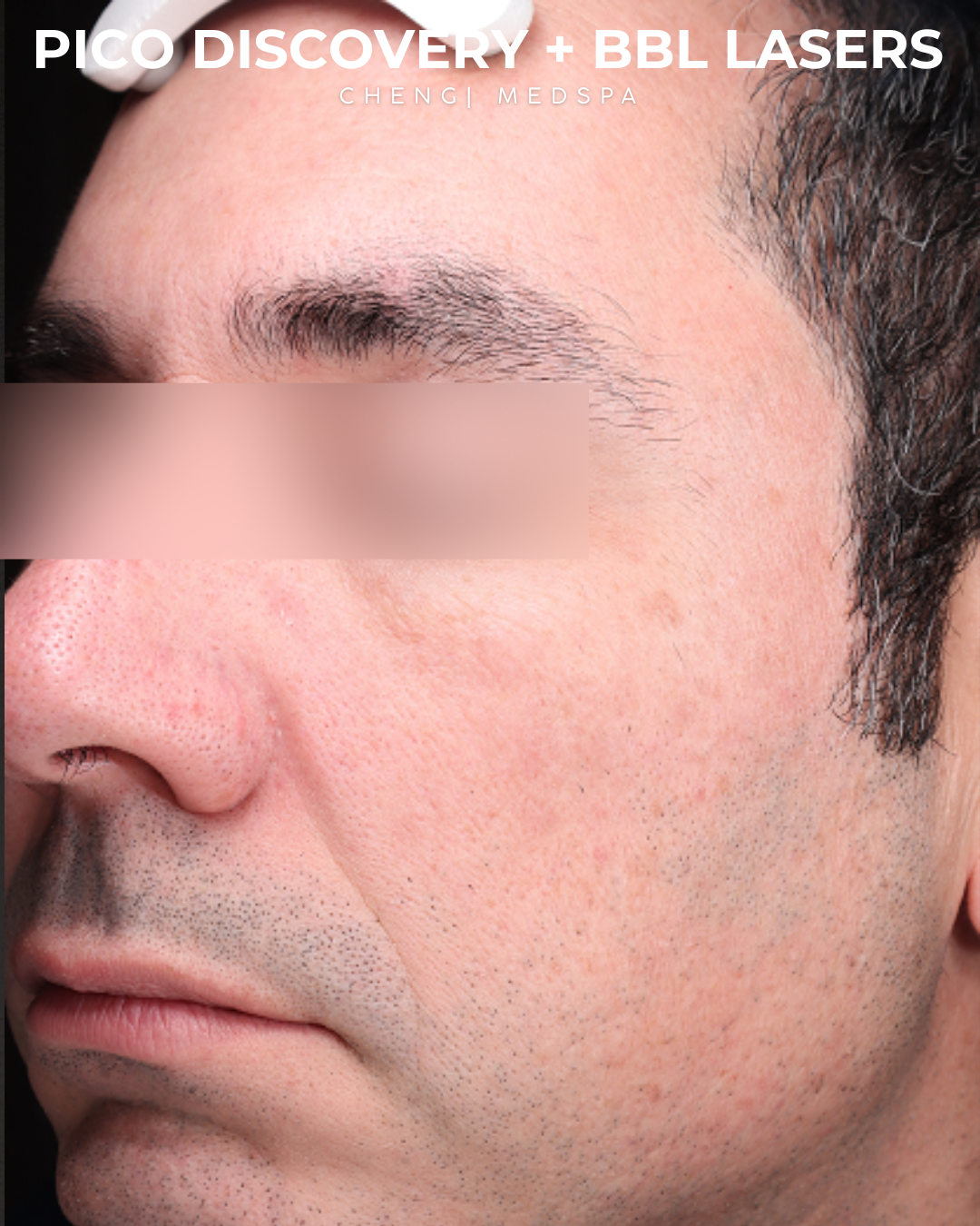 BBL Laser Before & After Gallery - Patient 286352 - Image 4