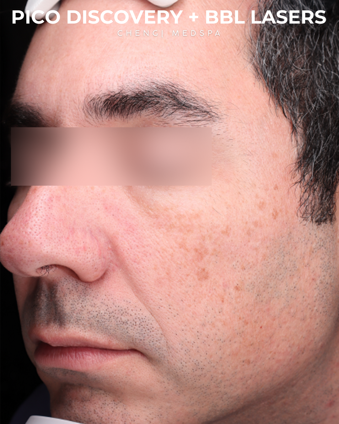 BBL Laser Before & After Gallery - Patient 286352 - Image 3