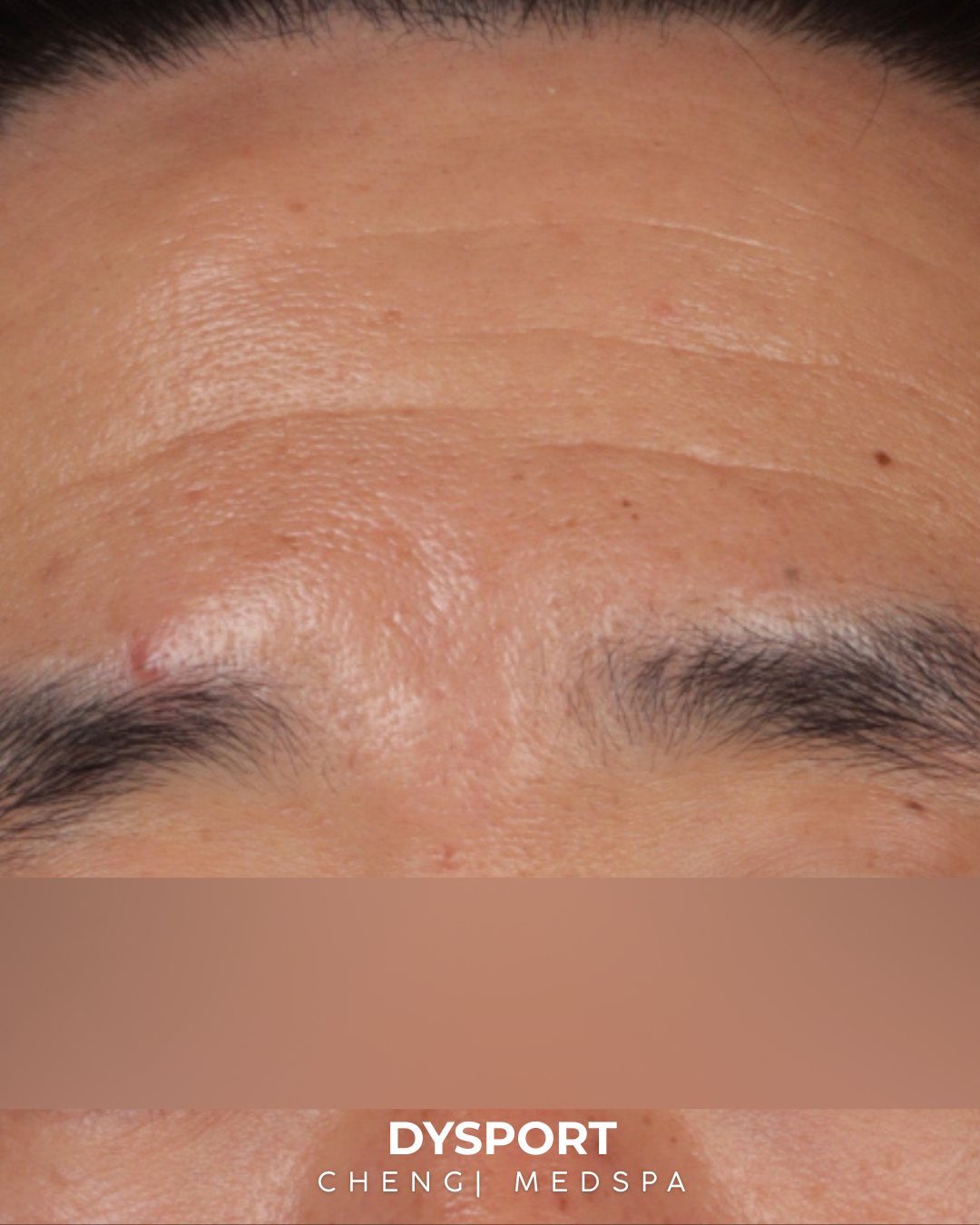 Botox and Dysport Before & After Gallery - Patient 318612 - Image 1