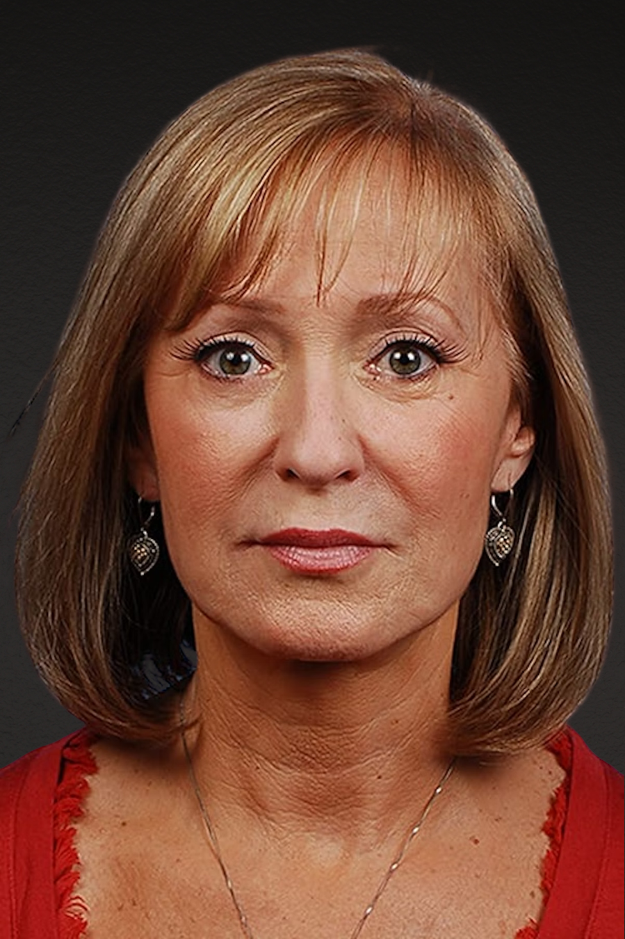 Facelift Before & After Gallery - Patient 423612 - Image 2