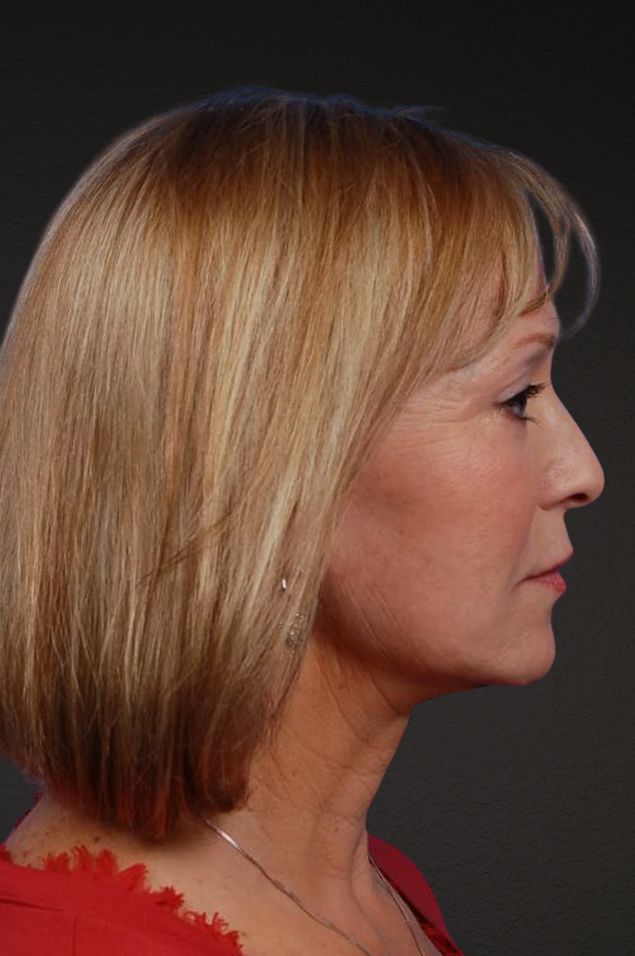 Facelift Before & After Gallery - Patient 423612 - Image 4