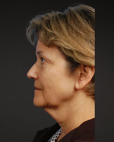 Facelift Before & After Gallery - Patient 976634 - Image 1