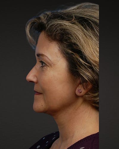 Facelift Before & After Gallery - Patient 976634 - Image 2