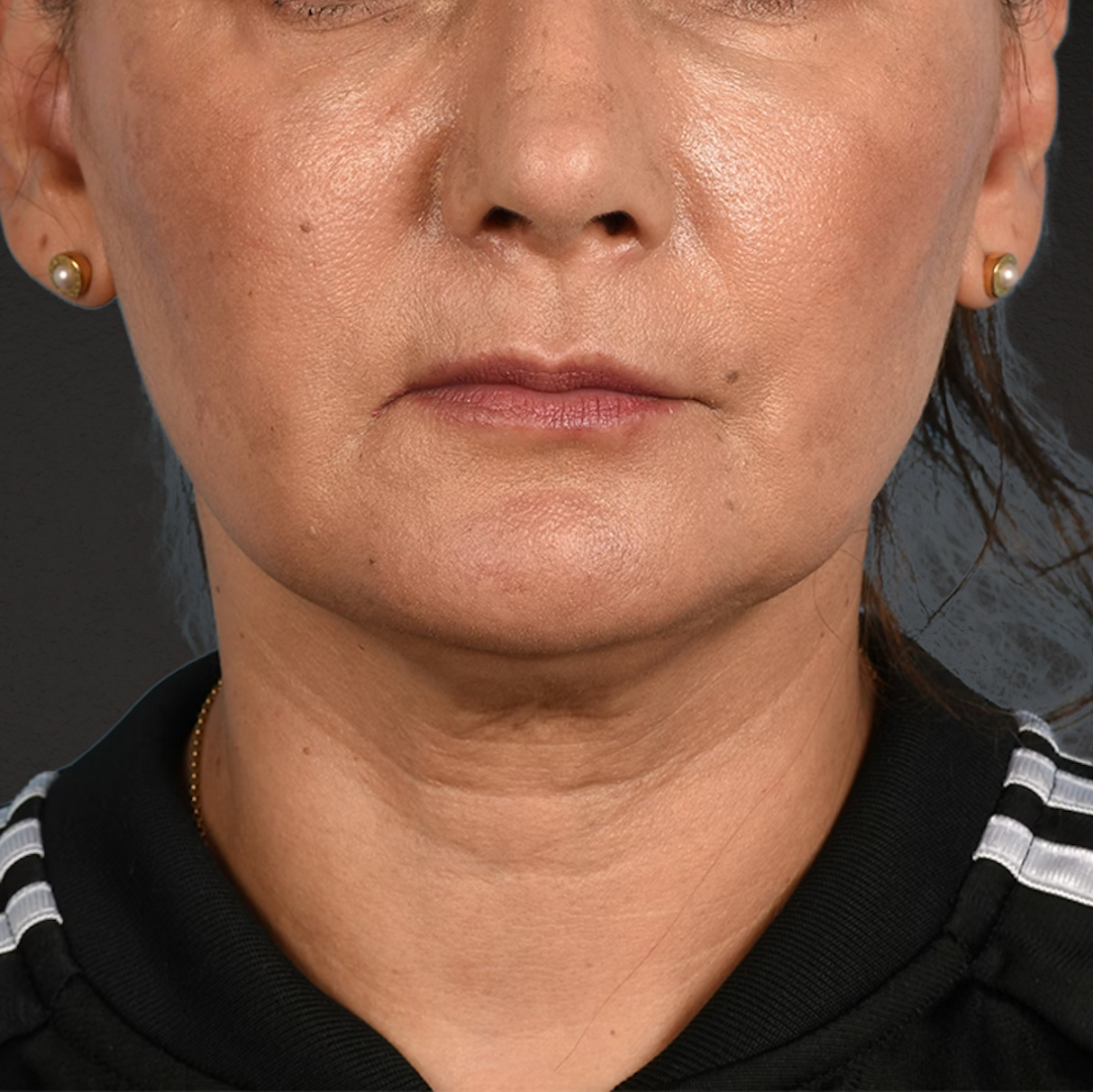 Facelift Before & After Gallery - Patient 230740 - Image 1