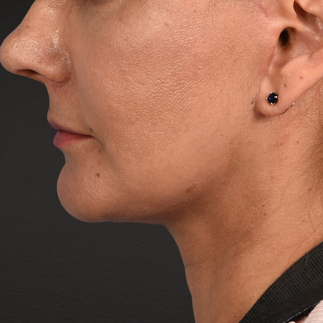 Facelift Before & After Gallery - Patient 230740 - Image 10