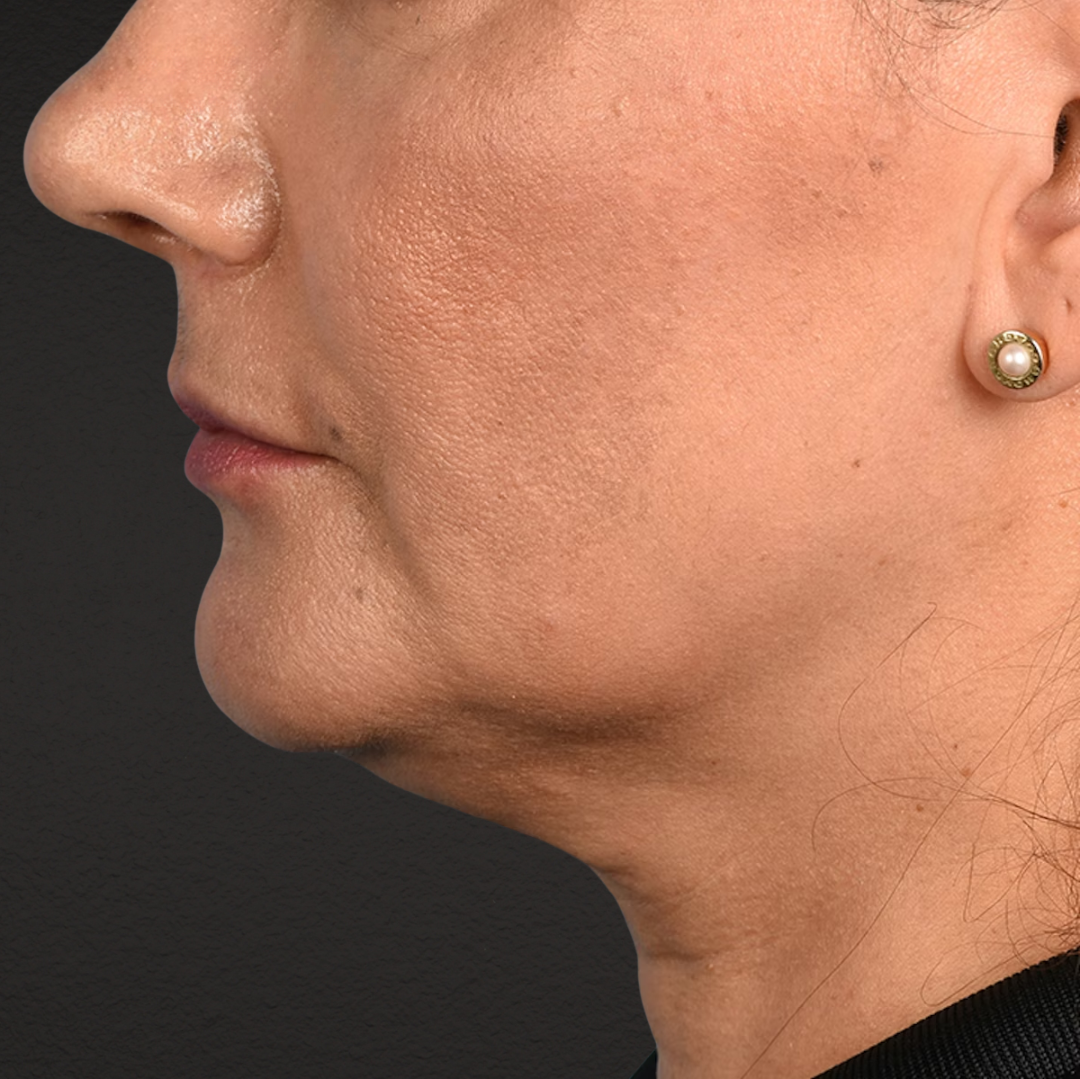 Facelift Before & After Gallery - Patient 230740 - Image 9