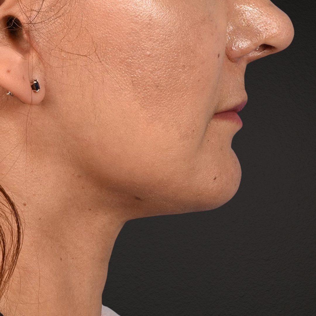 Facelift Before & After Gallery - Patient 230740 - Image 6