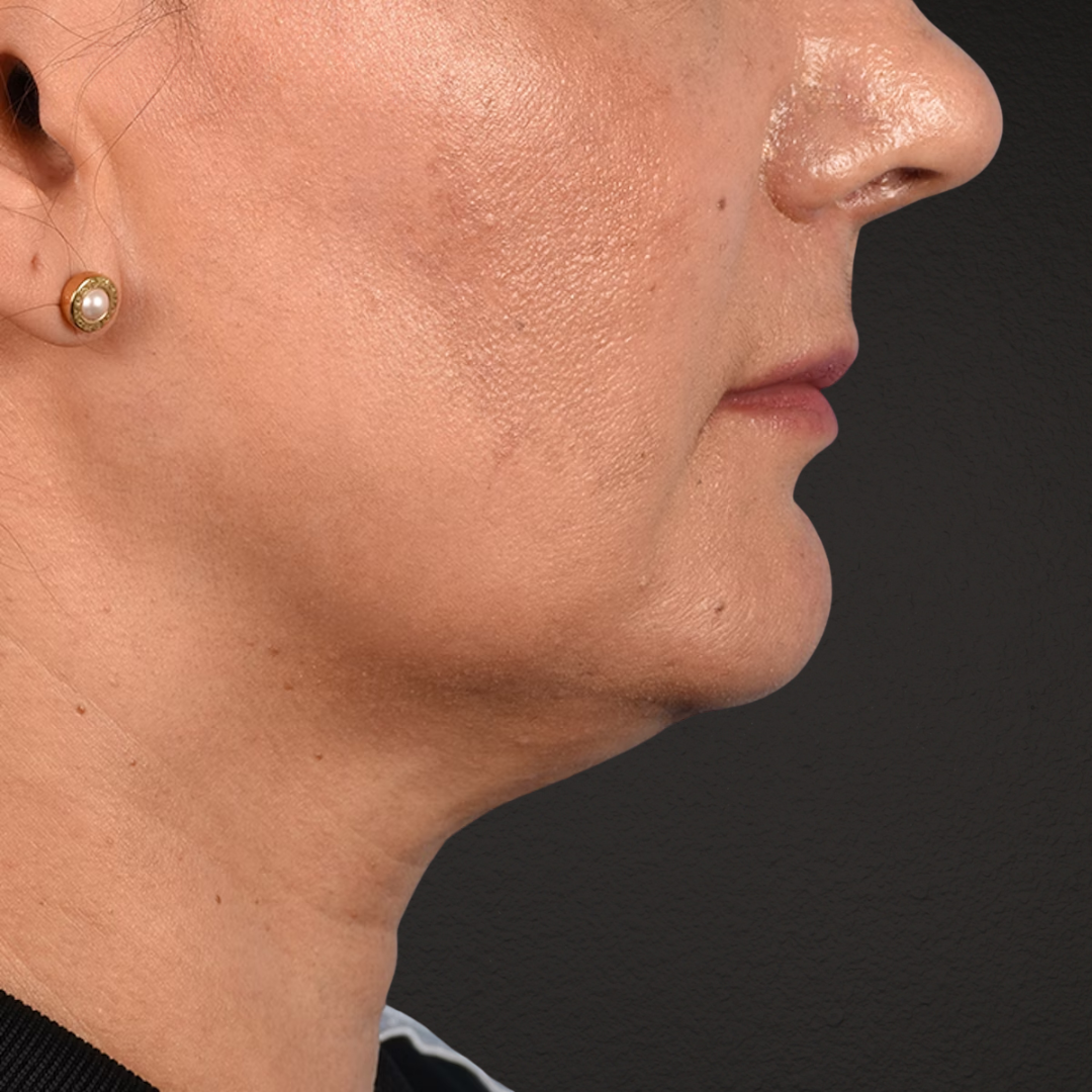 Facelift Before & After Gallery - Patient 230740 - Image 5