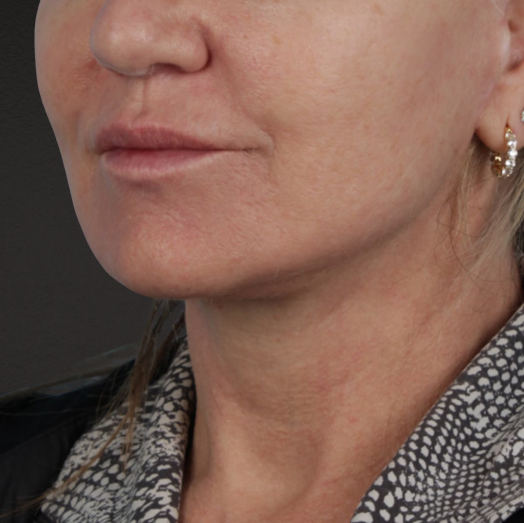 Facelift Before & After Gallery - Patient 315359 - Image 8