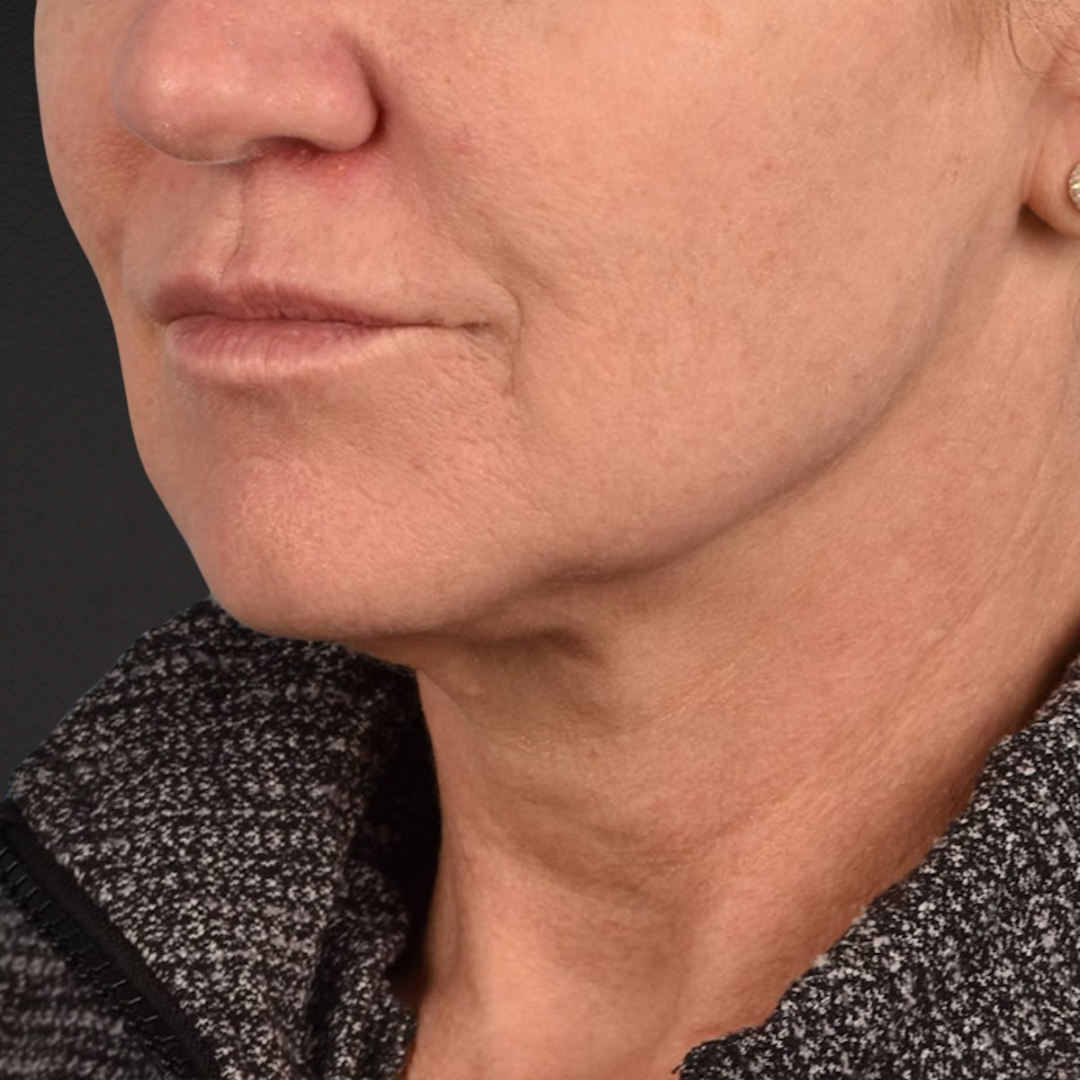 Facelift Before & After Gallery - Patient 315359 - Image 7
