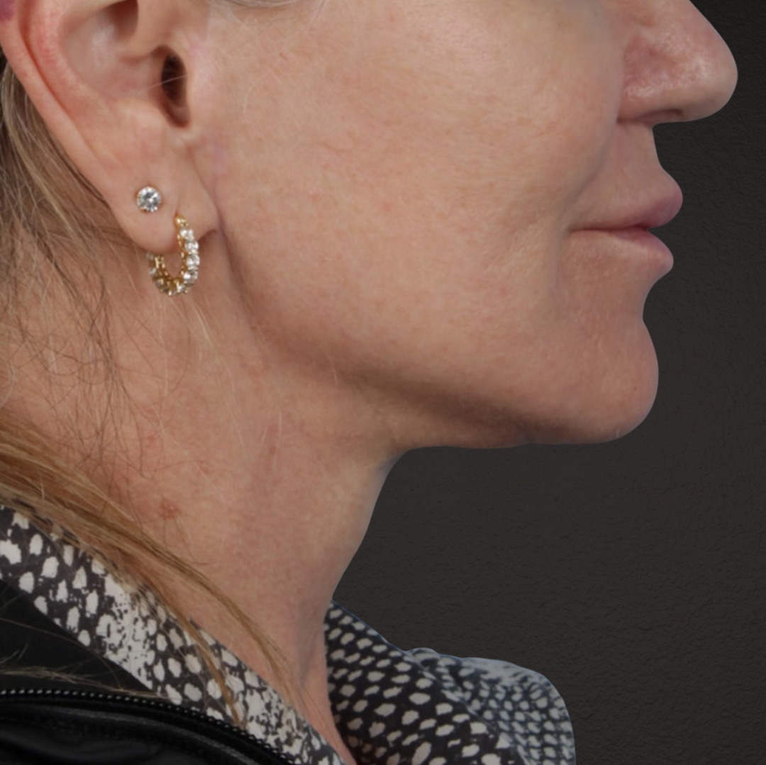Facelift Before & After Gallery - Patient 315359 - Image 6